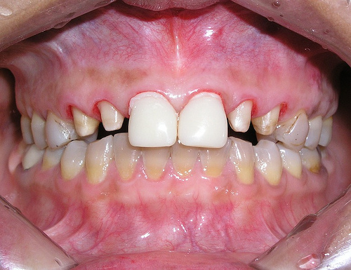 ảnh bệnh nhân được lắp răng tạm để bảo vệ cùi răng